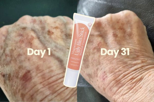 How Can I Fade Sun Spots Naturally?