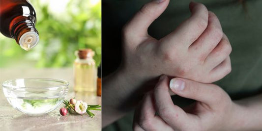 Scabies: Effective Natural Remedies To Help Soothe & Heal